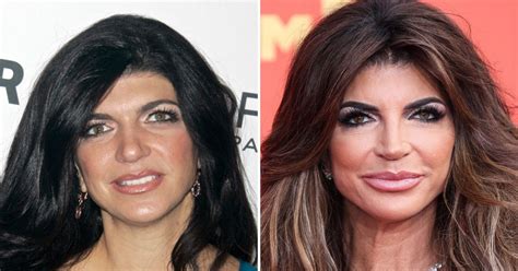 Teresa Giudice Plastic Surgery Photos: Before and After